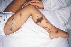 purpura palpable en paciente con sepsis meningoccica (JAAD nov 2000)