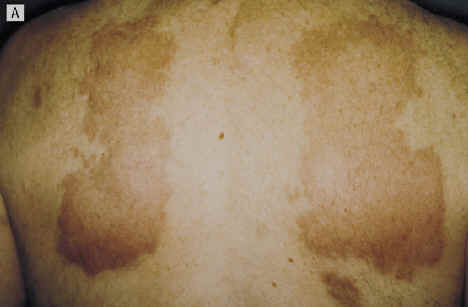 Imagen clnica de lesiones cutneas en un paciente con sndrome de Churg-Strauss. Placas eritematosas infiltradas, de crecimiento centrfugo en torso. Termer CC et al. Arch dermatol 2001, 137:136.