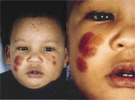 Placas purpuricas y equimóticas en forma de roseta.Thomas Millard, Alex Harris, Donald MacDonald.Acute infantile hemorrhagic oedema.J Am Acad Dermatol 1999;41:837-9.)