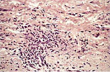Vasculitis leucocitoclástica Thomas Millard, Alex Harris, Donald MacDonald.Acute infantile hemorrhagic oedema.J Am Acad Dermatol 1999;41:837-9.)