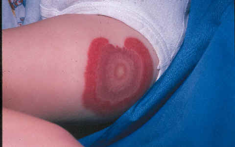 Edema agudo hemorragico del lactante (Finklestein). Niño de 3 años con buen estado general, que desarrolló de forma brusca las esiones cutaneas que se ilustran en las imágenes. Herb Goodheart, NYC . Dubin BA, et al (Acute hemorrhagic edema of childhood.