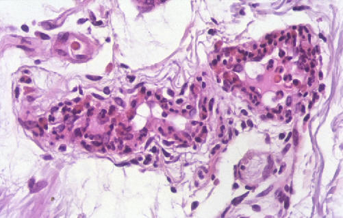 Vasculitis leucocitoclstica. El estudio histolgico de las fases iniciales muestra edema endotelial e infiltracin de la pared por polimorfonucleares neutrofilos.