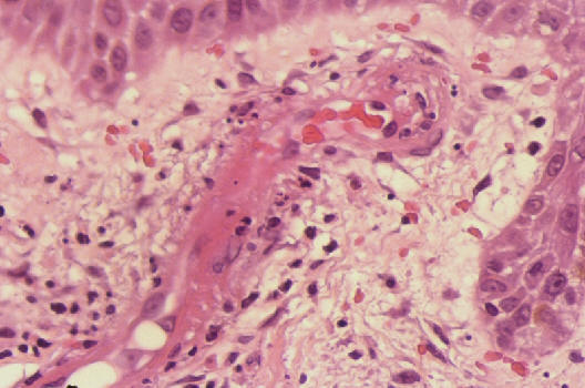 Vasculitis leucocitoclstica. Detalle de un vaso en dermis papilar mostrando edema endotelial, infiltrado inflamatorio polimorfonuclear, leucocitoclasia, hemorragia y depositos de fibrina.