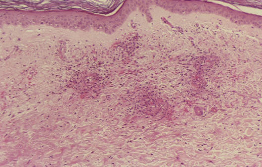 Biopsia cutnea de un paciente con vasculitis leucocitoclstica mostrando los hallazgos caracterticos (edema, infltrado por PMN, leucocitoclasia, hemorragia y trombosis, afectando a varios vasos localizados en dermis papilar y media.