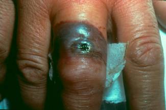 Esta imagen de antrax cutneo es la mano de un veterinario que se contagio de carbunco o antrax por la manipulacin de animales infectados (From file of Robert Aylesworth, MD)  