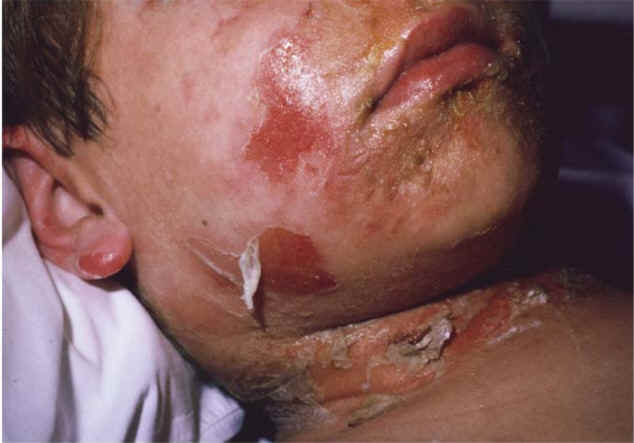 Staphylococcal Scalded Skin Syndrome