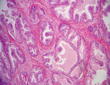 próstata histología normal tăieturi în abdomenul inferior prostatita