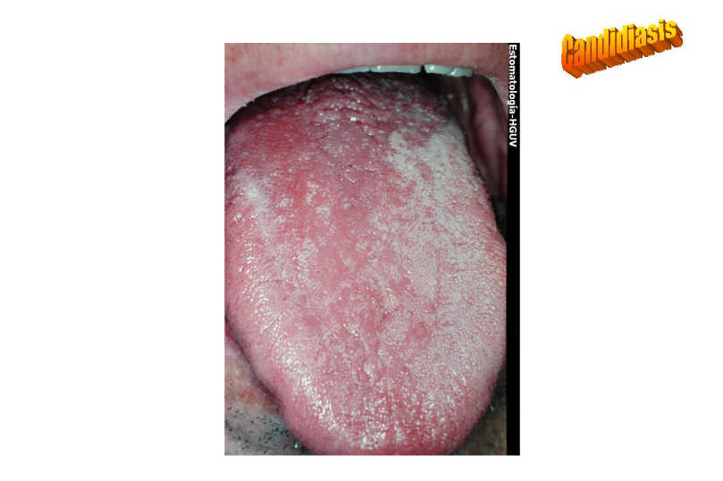 ENFERMEDAD DE SJOGREN