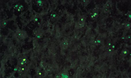 Patrn nucleolar. Gallart Gallart T. Principales pruebas inmunolgicas de inters clnico. cap 381. en Farreras Rozman  Medicina interna. XIV ed. 2000 ediciones Harcourt.