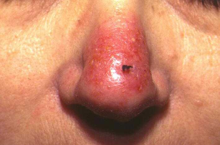 Fotosensibilidad en pacientes con lupus eritematoso. Paciente con lupus sistmico que tras una corta exposicin solar desarrolla lesiones papulo vesiculares y pustulosas en dorso de nariz