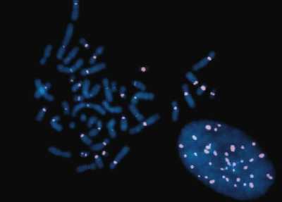 preparacin de cromosomas en metafase utilizados como sutrato de una inmunofluorescencia indirecta con suero de un paciente con anticueropos anticentrmero (identificado con rodamina).Wigley FM,  Provost TT. Scleroderma. in Cutaneous medicine. BC. Deckered 2001.
