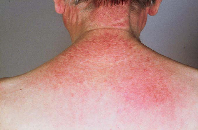 Poiquilodermia en base de cuello caracterstica de la dermatomiositis (signo del chal)Trueb RM. Dermatomyositis. Dermatologic therapy 2001, 14:70.