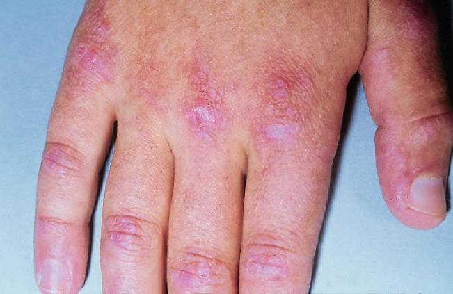 Ppulas de gottron  patognomonicas de dermatomiositis afectando al dorso de las articulaciones interfalangicas.Trueb RM. Dermatomyositis. Dermatologic therapy 2001, 14:70.