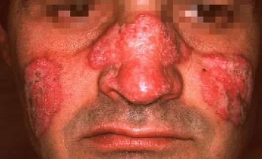 Lupus eritematoso cutneo Crnico discoide.Placas eritematosas con reas atrficas y hiperqueratosis de predominio folicular. Lachapelle JM: Atlas of Dermatology. UCB pharmaceuticals