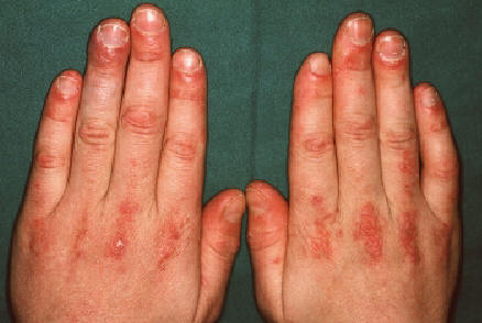 Dermatomiositis. papulas eritematosas con discreta hiperqueratosis en dorso de articulaciones interfalngicas y metacarpofalngicas. Papulas de Gottron. Lachapelle JM: Atlas of Dermatology. UCB pharmaceuticals