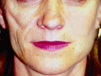 Atrofia grasa afecntado a lamejilla derecha en una mujer con esclerodermia lineal. Connolly MK. Dermatologic Therapy 2001, 14:81.