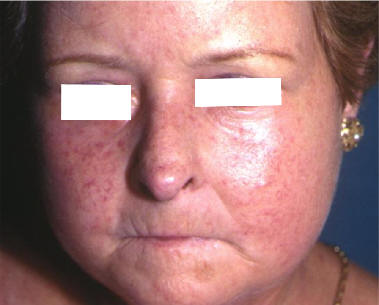 Cambios faciales en una paciente con esclerodermia sistemica limitada (CREST), esclerosis cutnea, telangiectasias faciales.