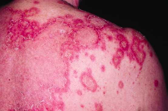 Lesiones cutneas de lupus eritematoso subagudo.  Callen JP. Therapy of cutaneous lupus erythemaotosus. Dermatologic Therapy, 2001, 14:61.