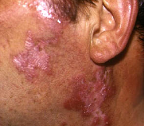 Lupus eritematoso cutneo crnico. Rash discoide.