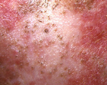 Lupus eritematoso cutneo crnico. Rash discoide. Detalle mostrando la atrofia cutnea con queratosis folicular