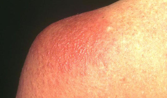 Fotosensibilidad en lupus eritematoso. Placa eritemato vesicular tras una breve exposicin solar.