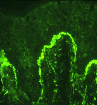 Lupus eritematoso cutneo crnico, inmunofluorescencia directa positiva mostrando depositos de IgG a nivel de la membrana basal.