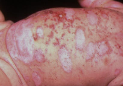 Lupus neonatal. Placas anulares, eritematosas, psoriasiformes tras una exposicin solar.