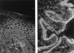 Hashimoto T. Immunopathology of PNP pemphigus.  Clinic in derm 2001, 19:675-682