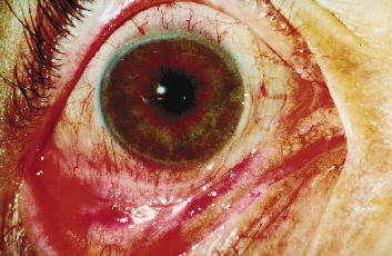 Ghohtestani RF. Color atlas:autoimmune blistering skin diseases. Clin Dermatolo 2001;19:642