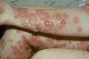 Penfigoide ampolloso. Multiples lesiones ampollosas tensas en antebrazo (NLTS2)