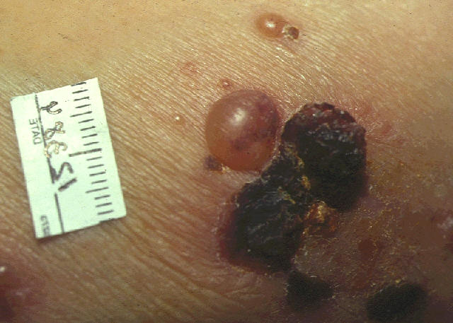 Penfigoide ampolloso. ampolla tensa subepidermica juntoa lesiones cubiertas de costras