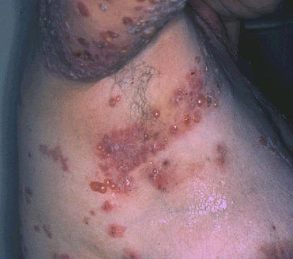 Penfigoide ampolloso. Multiples ampolla tensas afectando a pliege axilar