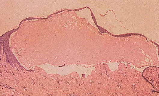 Penfigoide ampolloso. ampolla subepidermica