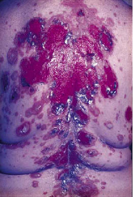 Nousari HC. Autoimmune bullous disease.  in Provost T. ed Cutaneous medicine. BC Decker Hamilton 2001.