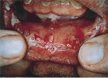  Hossein C. Nousari, MD. J Am Acad Dermatol 1999;40:750-4.