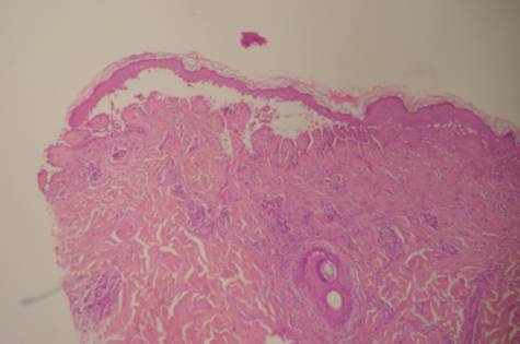 ampolla intraepidermica con acantolisis suprabasal