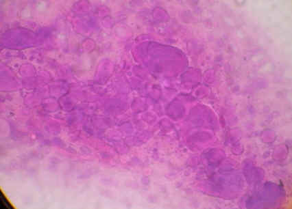 El test de tzanck del contenido de una de las vesculas mostr la presencia de clulas balonizadas y gigantes multinucleadas caractersticas de las infeccines por virus del herpes