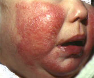 dermatitis aguda en ambas mejillas