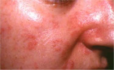 imágenes de eczema agudo, subagudo cronico