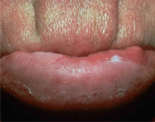 queilitis actnica en labio inferior (AAD)