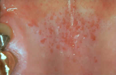 rea de eritroplasia en paladar (AAD)