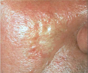 Carcinoma basocelular morfeiforme (AAD)