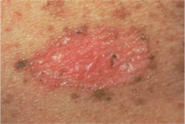 Check spelling or type a new query. Carcinoma Basocellulare Morfeiforme . Imagenes Clinicas De Tipos De Carcinoma Basocelular
