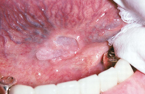 Lesin ulcerada en la base de la lengua. Carcinoma epidermoide.