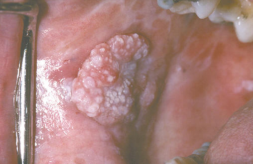 Lesin exoftica, papilomatosa en la mucosa oral. Carcinoma epidermoide.