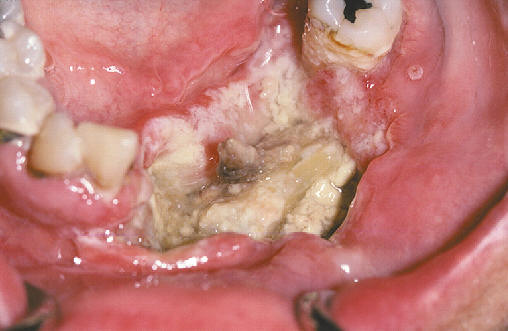 Lesion ulcerada profunda en la porcin anterior del suelo de boca y regin alveolar. Carcinoma epidermoide.