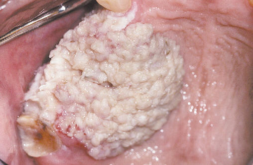 Lesion verrucosa,ecofitica  en regin maxilar. Carcinoma epidermoide (verrucoso)