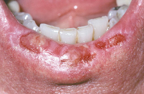 Lesiones características de queilitis actínicas con áreas atróficas, ulceradas del labio inferior. La biopsia mostró un carcinoma epidermoide incipiente.