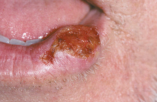 Lesion nodular ulcerada en labio inferior. Carcinoma epidermoide.