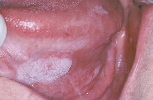 Leucoplasia. El estudio histológico mostró discreta displasia epitelial.